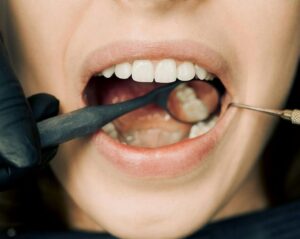 dental filling