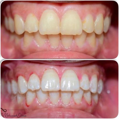 scaling,polishing (1)