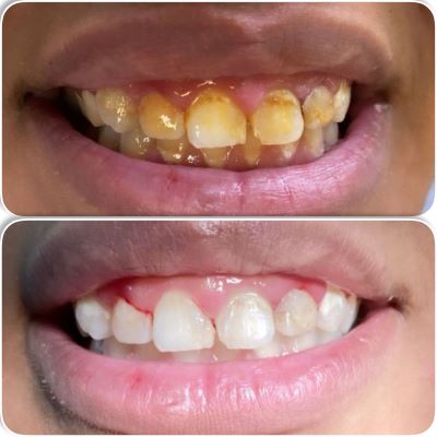 scaling,polishing (3)